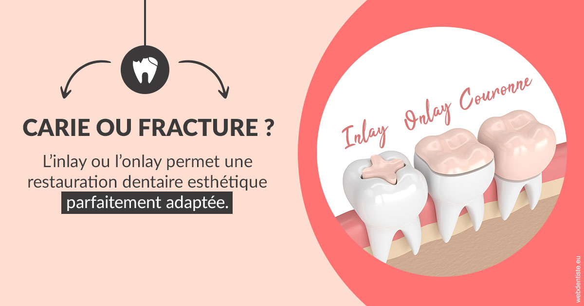 https://selarl-drs-choquin.chirurgiens-dentistes.fr/T2 2023 - Carie ou fracture 2