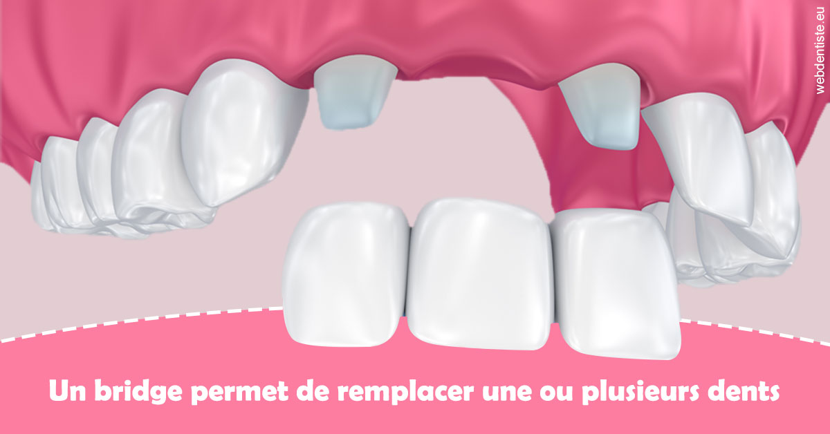 https://selarl-drs-choquin.chirurgiens-dentistes.fr/Bridge remplacer dents 2