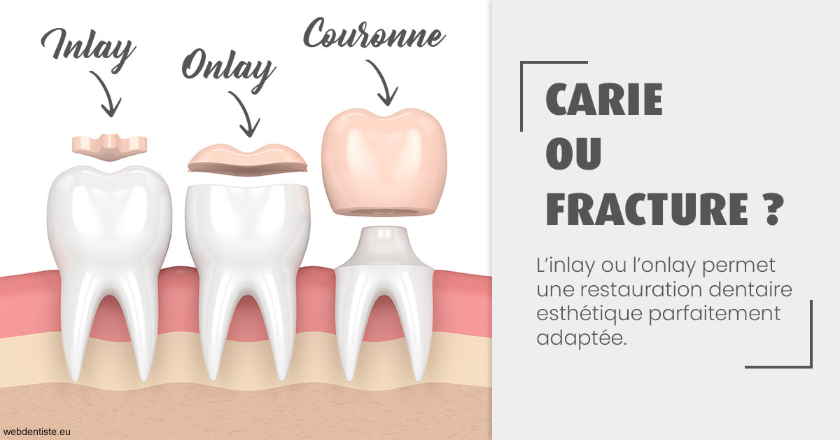 https://selarl-drs-choquin.chirurgiens-dentistes.fr/T2 2023 - Carie ou fracture 1