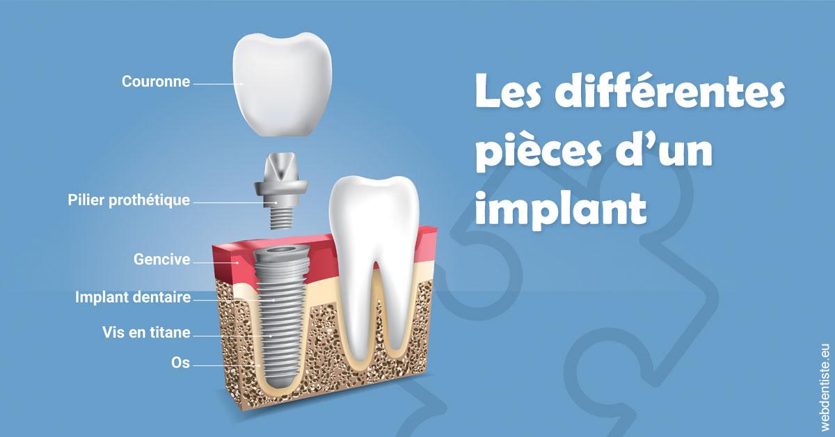 https://selarl-drs-choquin.chirurgiens-dentistes.fr/Les différentes pièces d’un implant 1